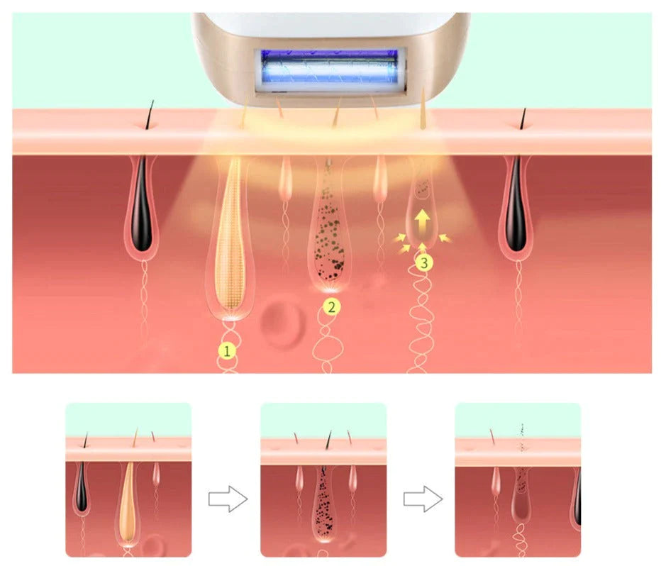 IPL Laser Hair Removal Device