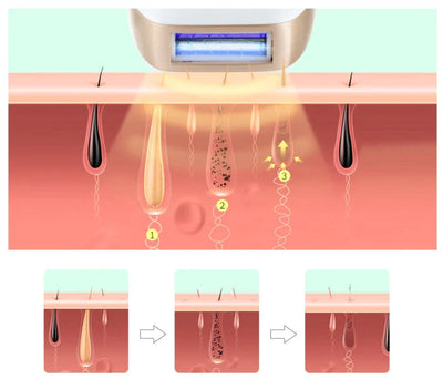 IPL Laser Hair Removal Device